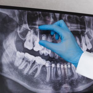 Dental professional looking at x-ray to prevent dental implant failure